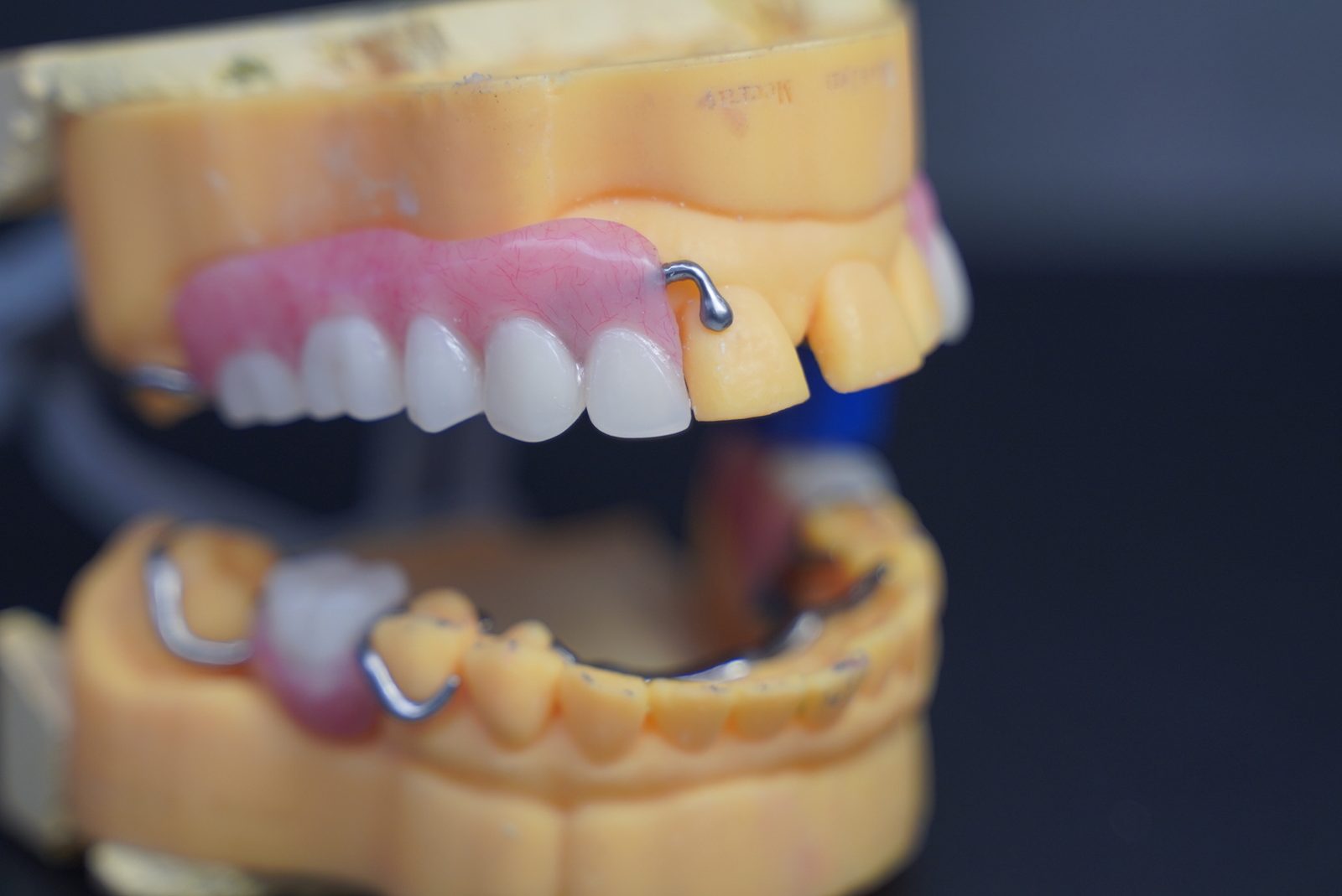 Upper anterior partial denture with wrought clasps on a working model