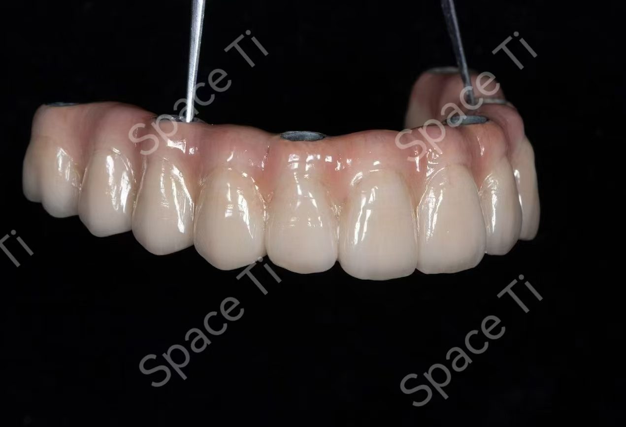 Space Ti implant-supported full-arch bridge restoration